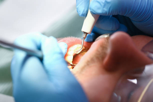 Best Emergency Dental Extractions in Bowling Green, MO